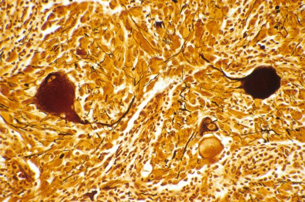 18C2 Ganglioglioma (Case 18) Biels