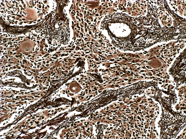 18D Ganglioglioma (Case 18) Retic 1