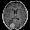 19A1 Ganglioglioma (Case 19) T1W 1 - Copy