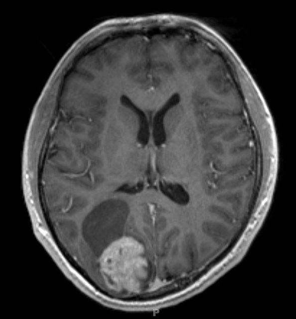19A1 Ganglioglioma (Case 19) T1W 1 - Copy