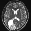 19A2 Ganglioglioma (Case 19) T2 1 - Copy