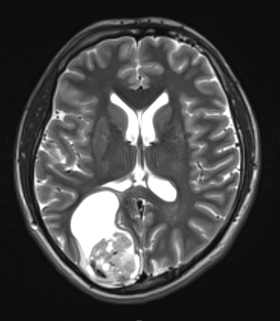 19A2 Ganglioglioma (Case 19) T2 1 - Copy