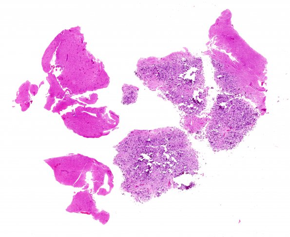 19B1 Ganglioglioma (Case 19) H&E whole mount