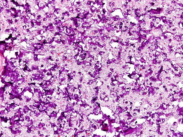 19B2 Ganglioglioma (Case 19) H&E 23.jpg