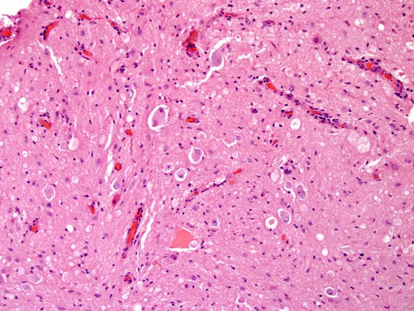 19B3 Ganglioglioma (Case 19) H&E 7.jpg