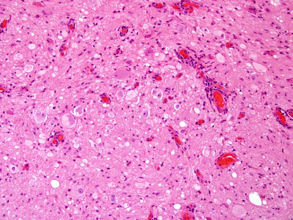 19B4 Ganglioglioma (Case 19) H&E 29.jpg