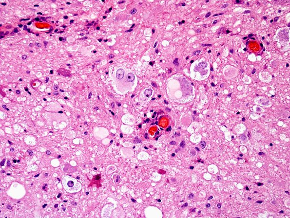 19B5 Ganglioglioma (Case 19) H&E 9