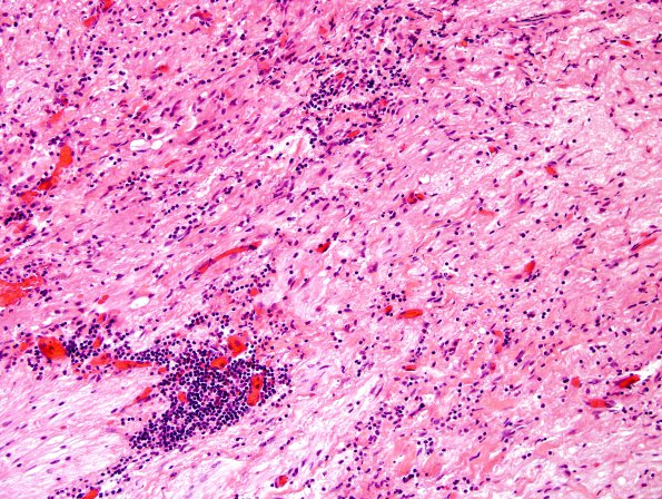 19B6 Ganglioglioma (Case 19) H&E 11.jpg