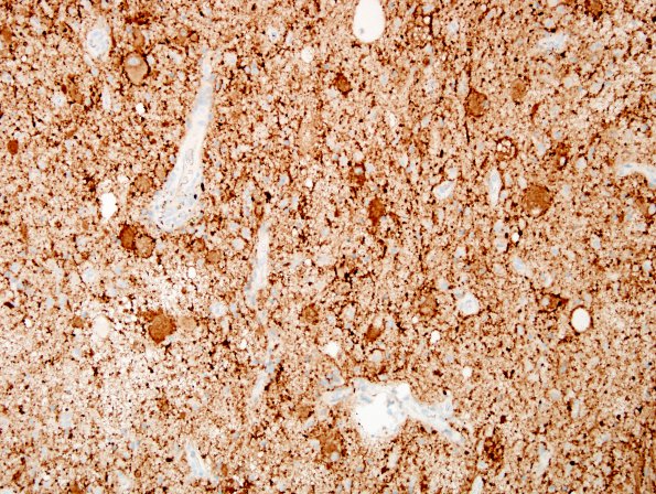 19C Ganglioglioma (Case 19) SYN 2.jpg