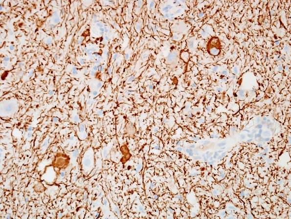 19D Ganglioglioma (Case 19) NF 1.jpg