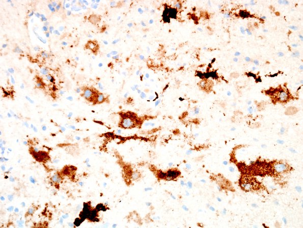 19E1 Ganglioglioma (Case 19) Chrom 6.jpg