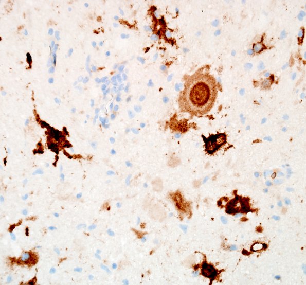 19E2 Ganglioglioma (Case 19) Chrom 2.jpg
