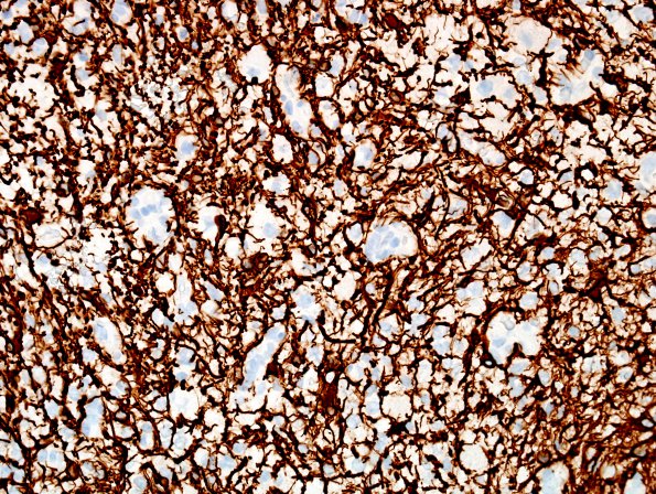 19F Ganglioglioma (Case 19) GFAP 3.jpg