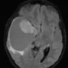 1A1 Ganglioglioma (Case 1) FLAIR 1 - Copy