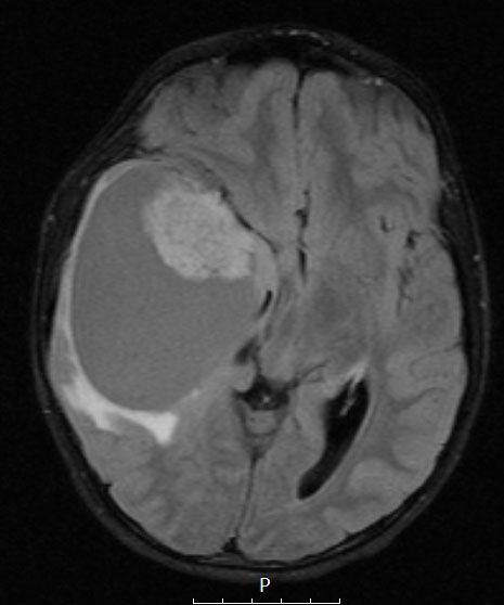 1A1 Ganglioglioma (Case 1) FLAIR 1 - Copy