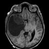 1A2 Ganglioglioma (Case 1) T1 1 - Copy