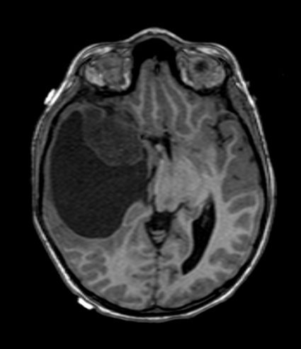 1A2 Ganglioglioma (Case 1) T1 1 - Copy