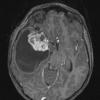 1A3 Ganglioglioma (Case 1) T1W 1 - Copy