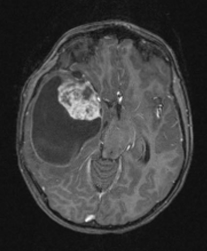 1A3 Ganglioglioma (Case 1) T1W 1 - Copy