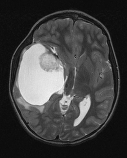 1A4 Ganglioglioma (Case 1) T2W 1 - Copy