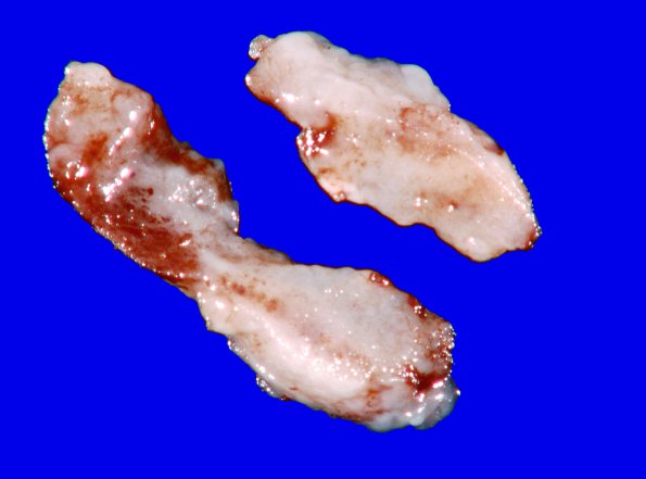 1B2 Ganglioglioma (Case 1) Gross_2