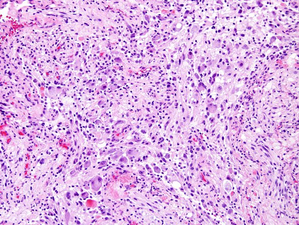 1C2 Ganglioglioma (Case 1) H&E 1