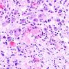 1C3 Ganglioglioma (Case 1) H&E 3