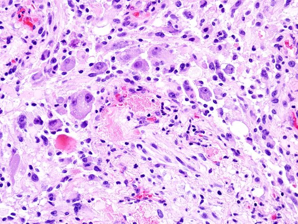 1C3 Ganglioglioma (Case 1) H&E 3