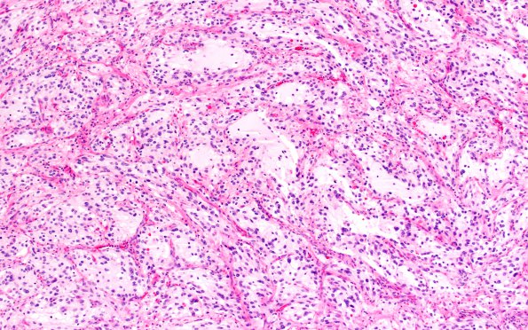 1C4 Ganglioglioma (Case 1) H&E 10X