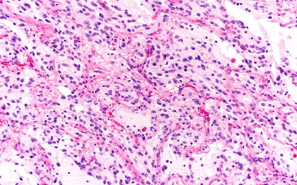 1C5 Ganglioglioma (Case 1) H&E 20X