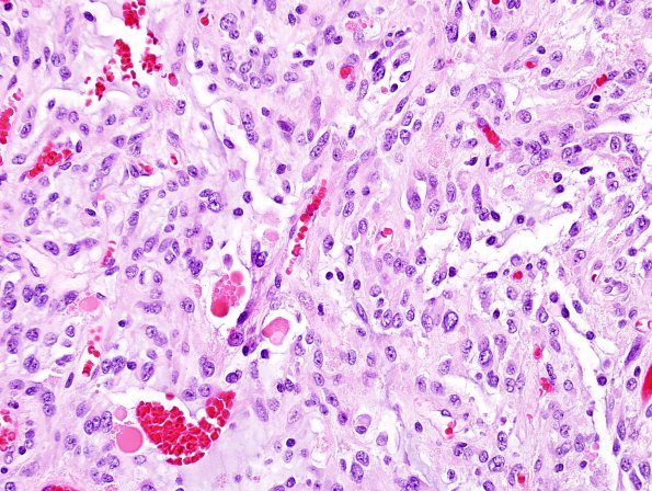 1C6 Ganglioglioma (Case 1) H&E 6