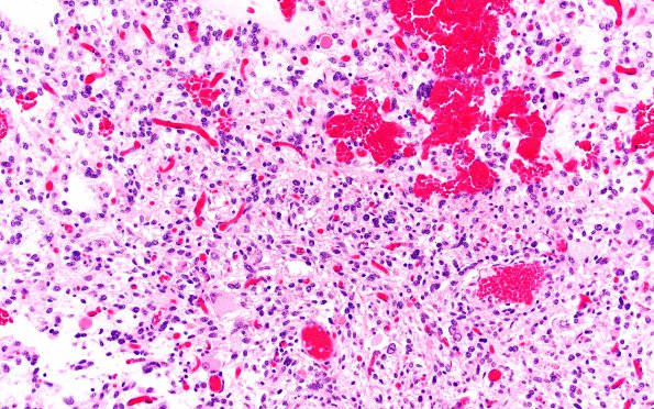 1C7 Ganglioglioma (Case 1) H&E 20X 2