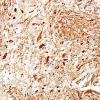 1D2 Ganglioglioma (Case 1) SYN 6