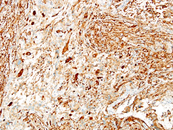 1D2 Ganglioglioma (Case 1) SYN 6