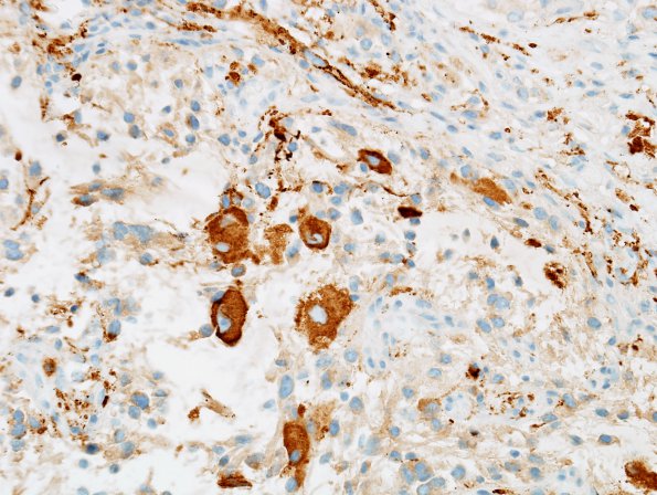 1D3 Ganglioglioma (Case 1) SYN 5