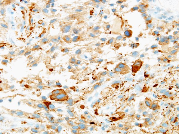 1D4 Ganglioglioma (Case 1) SYN 1