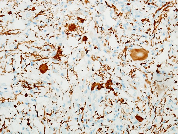 1E2 Ganglioglioma (Case 1) NF 2