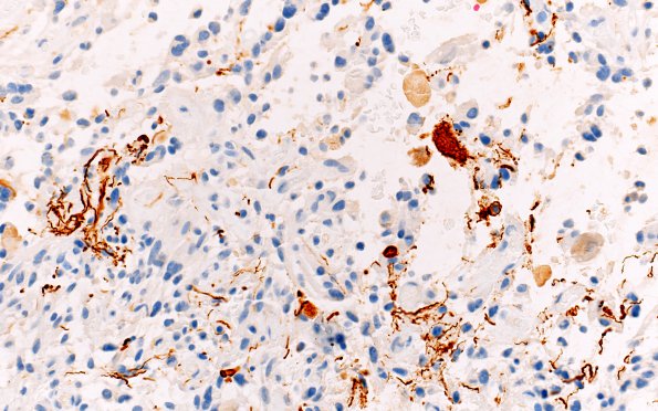 1E3 Ganglioglioma (Case 1) NF 40X