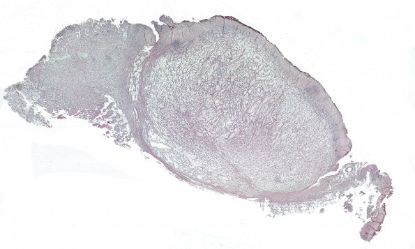 1G1 Ganglioglioma (Case 1) retic WM