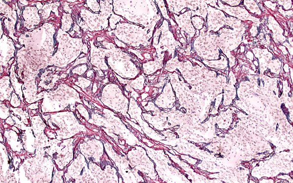 1G2 Ganglioglioma (Case 1) Retic 10X