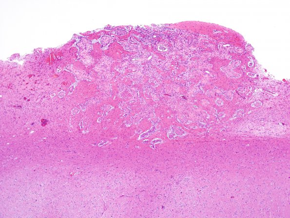 20A2 Ganglioglioma (Case 20) H&E 7