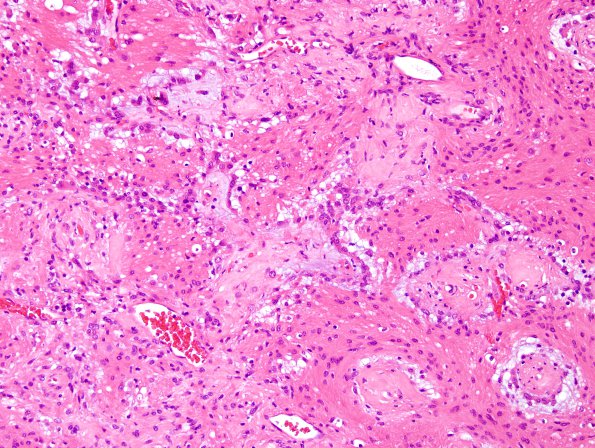 20A3 Ganglioglioma (Case 20) H&E 6