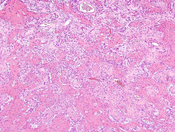 20A4 Ganglioglioma (Case 20) H&E 5