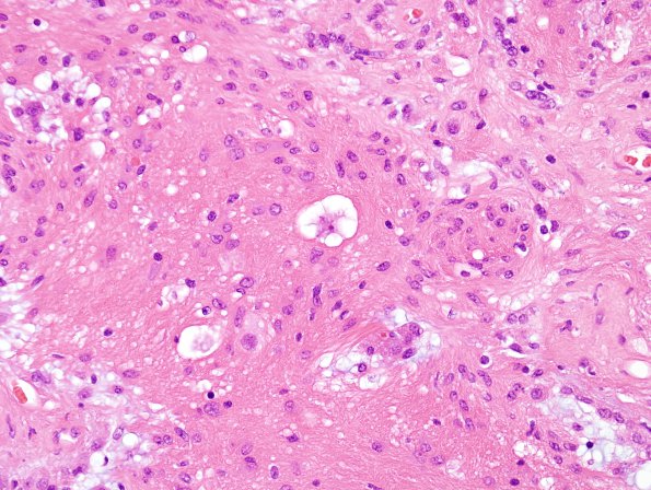 20A5 Ganglioglioma (Case 20) H&E 1