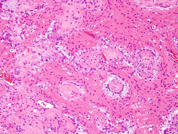 20A6 Ganglioglioma (Case 20) H&E 4