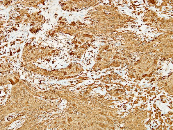 20B Ganglioglioma (Case 20) GFAP