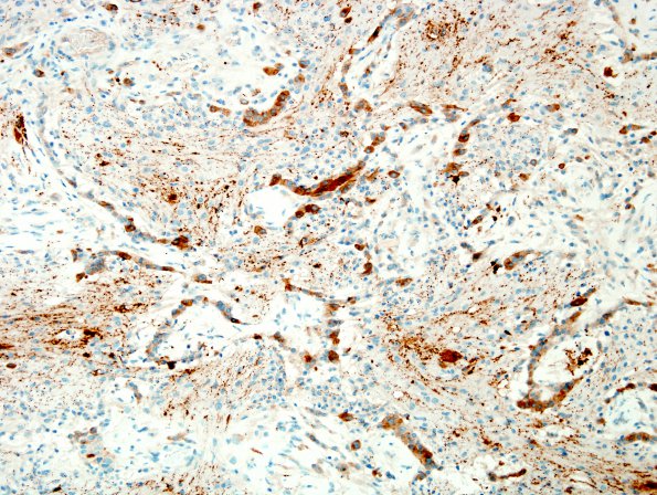 20C Ganglioglioma (Case 20) SYN