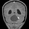 21A Ganglioglioma (Case 21) T1W 1 - Copy