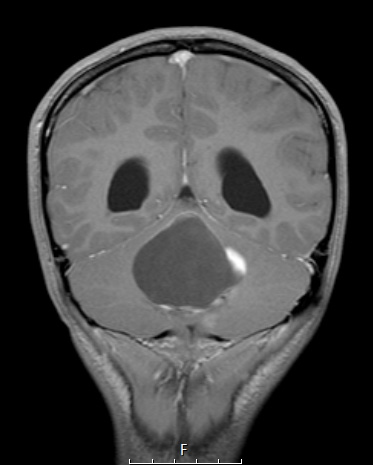 21A Ganglioglioma (Case 21) T1W 1 - Copy