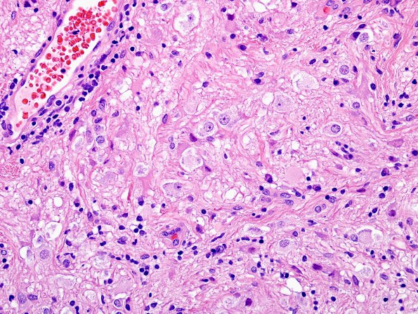 21B1 Ganglioglioma (Case 21) H&E 8